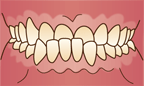 下顎前突(受け口)